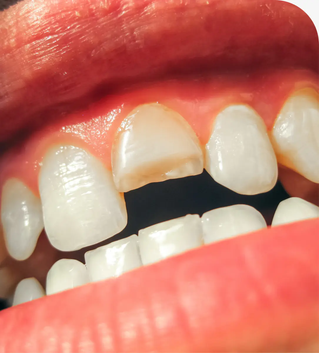 Dentures at Brazos River Dental in Mineral Wells