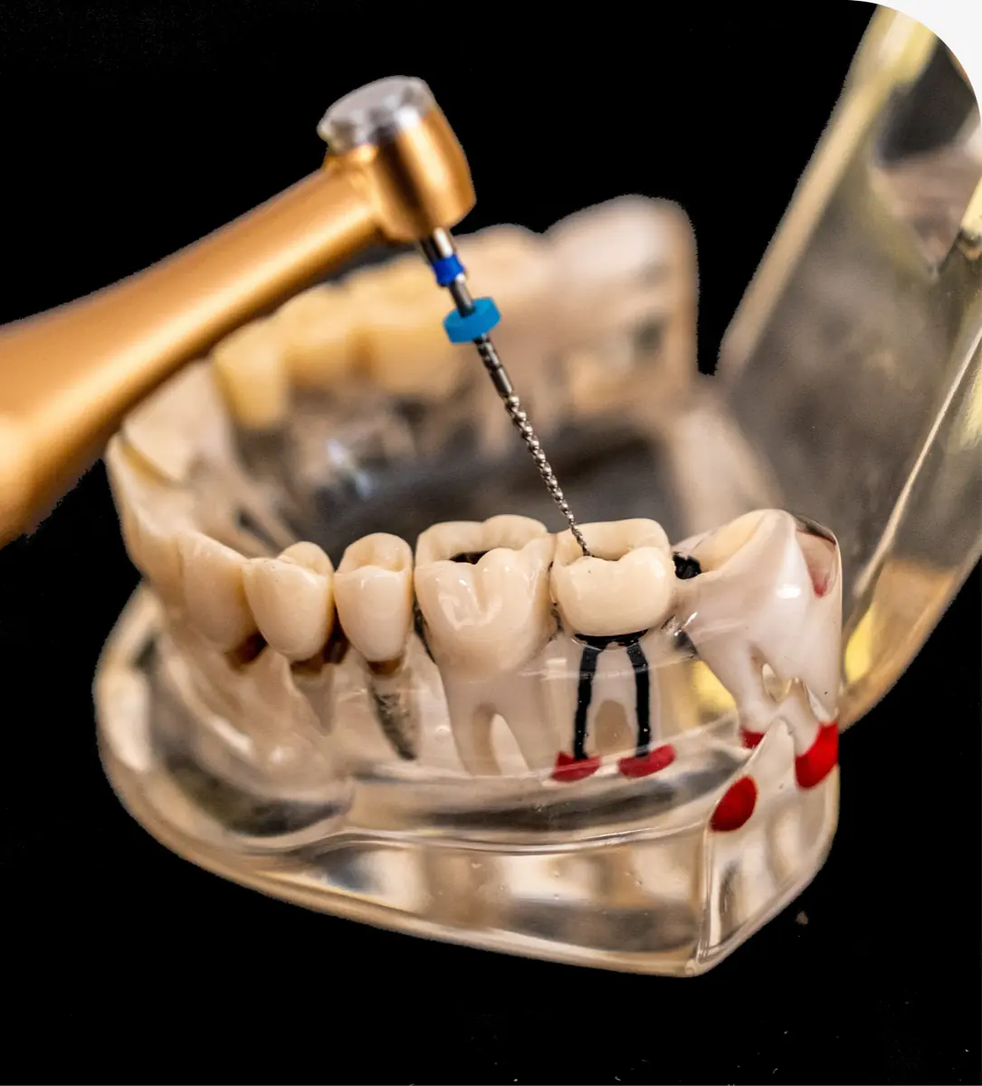 Endodontic treatment at Brazos River Dental in Mineral Wells