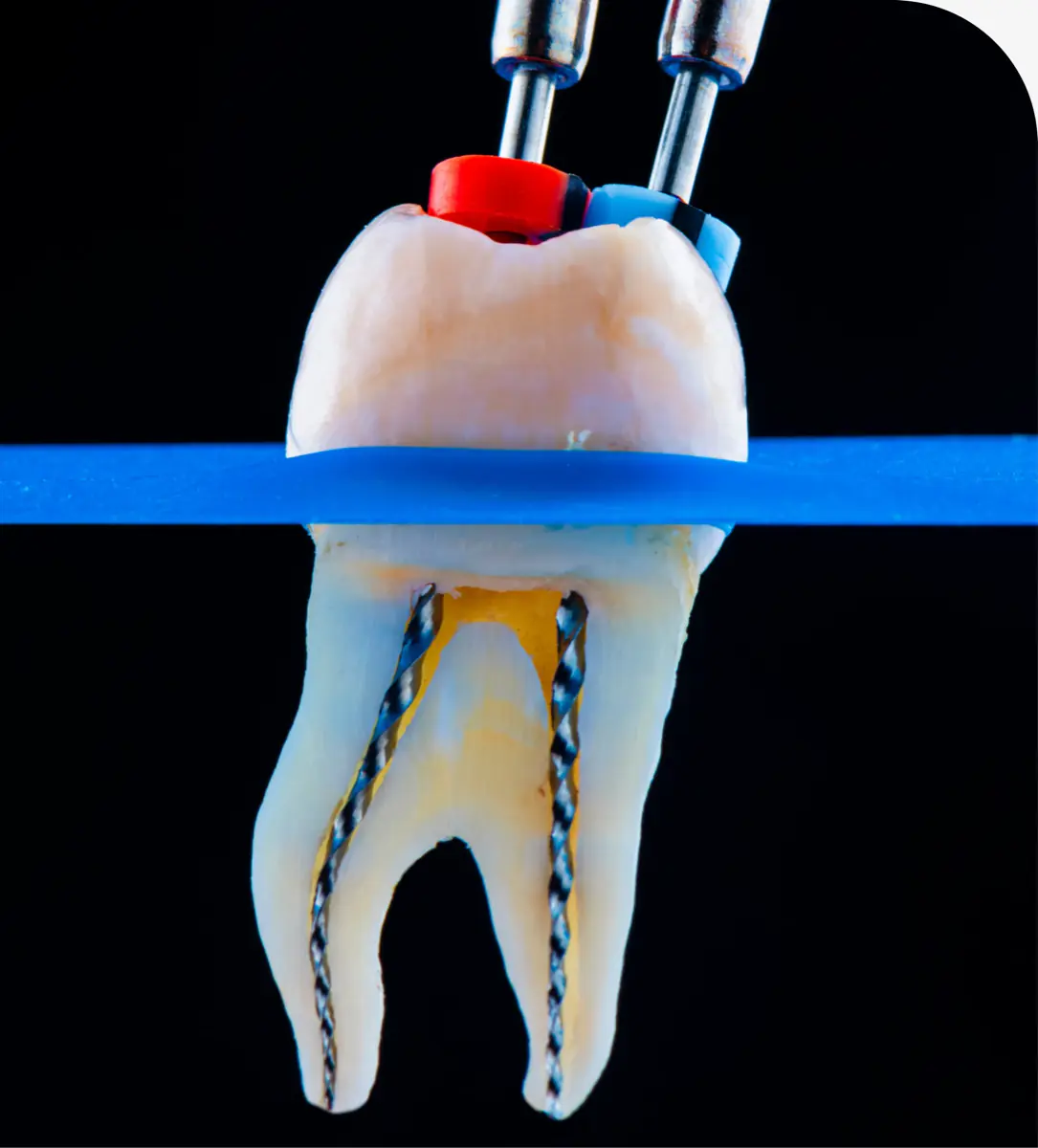 Root canal therapy at Brazos River Dental in Mineral Wells